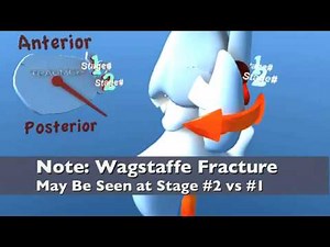 Lauge Hansen SER Supination External Rotation (Eversion) Ankle Fracture