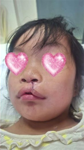 Smile haven CIHSR Nagaland for cleft patients