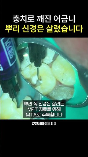 충치로 깨진 어금니, 뿌리 신경 살리는 VPT 치료 실제 과정