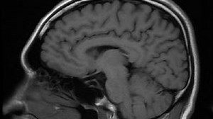 Autism early detection study says brain scan could catch signs earlier