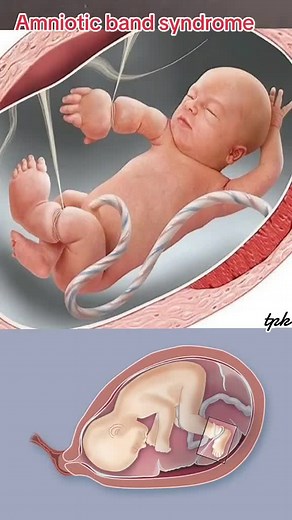 Understanding Amniotic Band Syndrome: Causes, Symptoms & Prevention