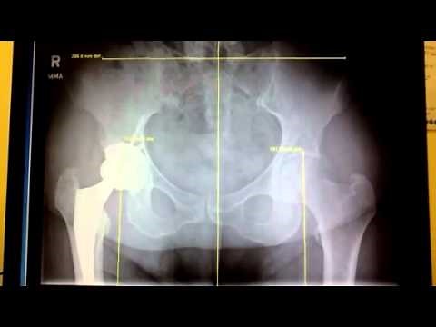 Hip Replacement Surgery and Short Leg Syndrome