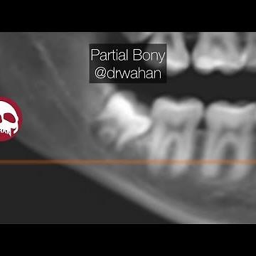 Mesioangular Wisdom Tooth Extraction Step by Step