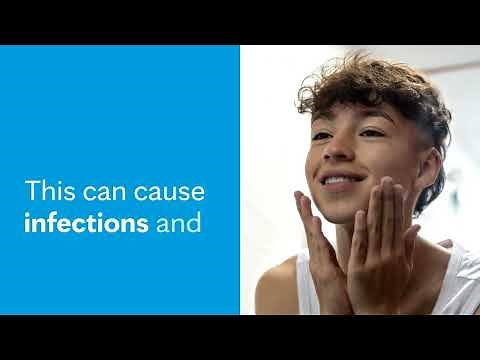 Managing acne: 10 tips to help your teen - Mayo Clinic Health System