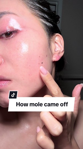 Truth About Mole Removal: A Journey with Alexandrite Laser