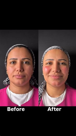 After one session skin booster | Dr_rawan saeed