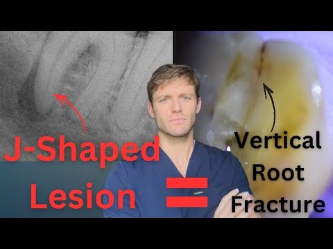 What a Tooth with a "Vertical Root Fracture" Actually Looks Like