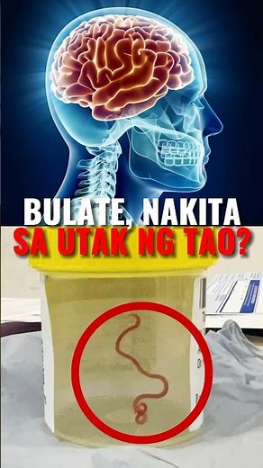 Bulate sa utak ng tao? #news #worm #brain #facts #viral