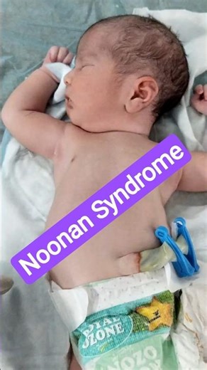 Noonan Syndrome #noonansyndrome #nicu #easymedicosis