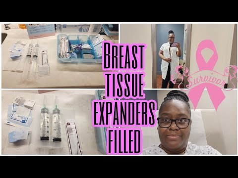 Double Mastectomy Breast Reconstruction Tissue Expanders Getting Filled Appointment