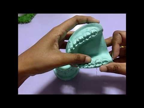 Ernst Ligature procedure for intermaxillary wiring on dental model