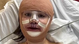 Influencer Dylan Mulvaney shows off bruised face after surgery