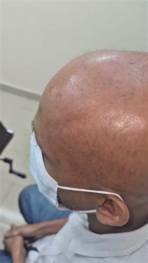 Alopecia Universalis treatment
