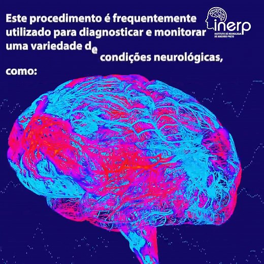 O mapeamento cerebral, também conhecido como eletroencefalograma (EEG) ou eletroencefalografia, é um exame não invasivo que registra a atividade elétrica do cérebro. Este procedimento é frequentemente utilizado para diagnosticar e monitorar uma variedade de condições neurológicas, sendo assim, uma ferramenta versátil e valiosa na prática clínica, ajudando no diagnóstico e tratamento de uma ampla gama de condições neurológicas. Precisando marcar seu exame de mapeamento cerebral? Entre em contato 