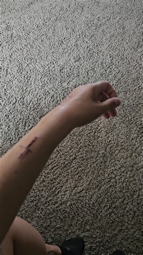 kienbocks disease kienbock's surgery #kienbocks #kienbocksdisease #surgery