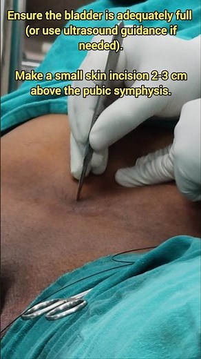 Suprapubic Pigtail Catheter Insertion Procedure | Step by Step #nursingexam #norcetmcq #neet #aiims