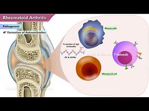 Rheumatoid Arthritis Animation: Etiology , Pathogenesis , Clinical features , Diagnosis & Treatment