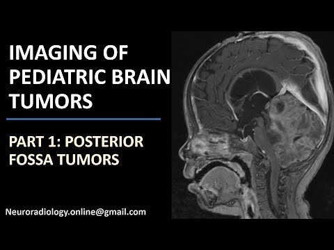 Imaging of Pediatric Brain Tumors (part 1): Posterior fossa tumors.