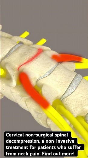 Non-surgical spinal decompression on the Hill DT table is a carefully guided medical event.