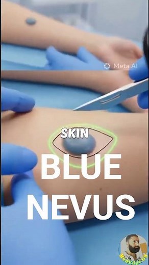 “Why This Blue Spot Appears on Your Skin | Blue Nevus Explained.