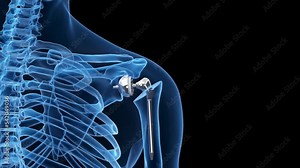 3d rendered medical animation of a shoulder replacement