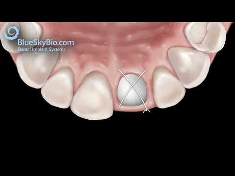 How a Single Dental Implant is Placed: Detailed Explanation