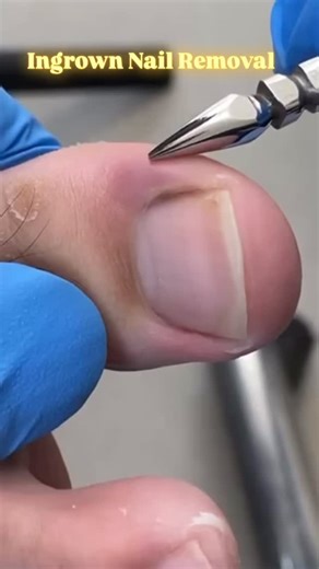 295K views · 4K reactions | The feeling after an ingrown nail...