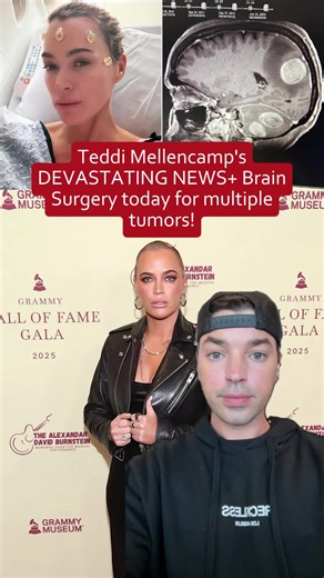 😢🏥 Breaking: Teddi Mellencamp Faces Devastating News, Undergoes Brain Surgery for Multiple Tumors Today #teddimellencamp #rhobh #realhousewivesofbeverlyhills #bravotv #twots #twotsinapod #celebrityhealth #realitystar #healthupdate #braintumor #celebritynews
