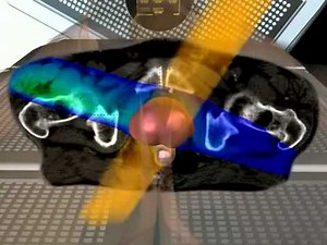 Intensity Modulated Radiation Therapy IMRT