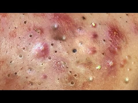 Multiple Blackheads and Whiteheads Removed Together,large blackheads and whiteheads treatment newest