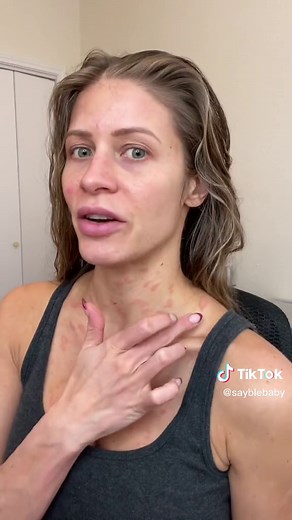 Understanding Pityriasis Rosea Rash: Symptoms and Treatment