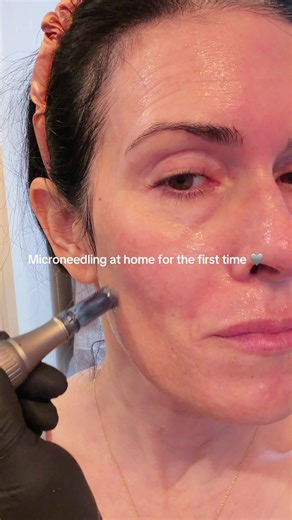 First time microneedling at home and it was a success! Huge thanks to @skinwithjayme for the amazing tips and tutorials. Let me know if you’d like to know what I used! I’ll link everything in my ShopMy too. 💕💕 #microneedlingathome #microneedling