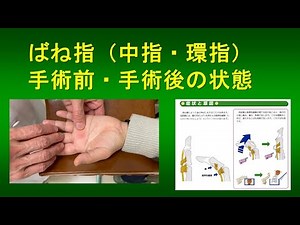 ばね指 手術前後の状態（2025.5症例提示）
