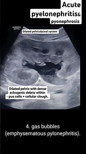 Acute pyelonephritis& pyonephrosis on ultrasound #radiology #ultrasound