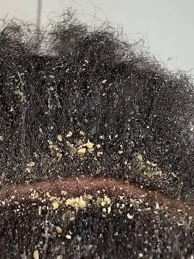 Dandruff asmr scratching removal on head using combing | Entertainment