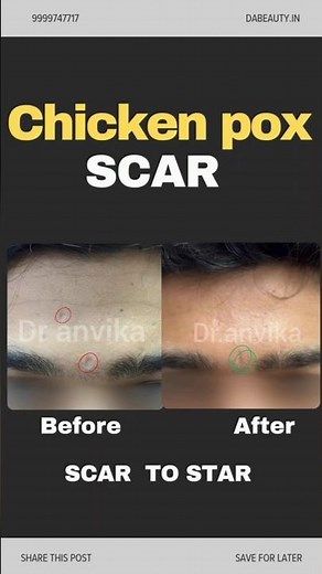 Chicken pox scars || How to Remove Chicken Pox Scars || Effective Scar Treatment || bye Dr Anvika