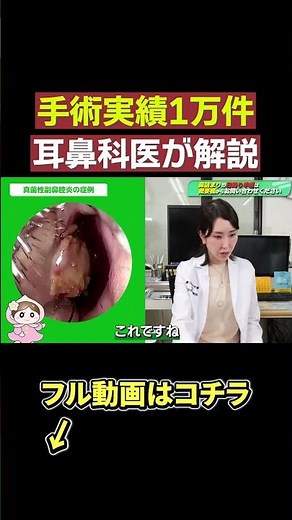 [Mold in the nose] This is how ENT surgery for sinusitis works