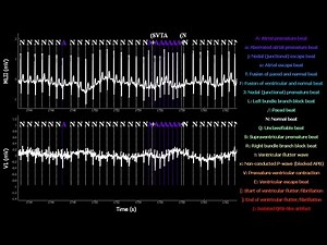 RealTime Electrocardiogram MIT-BIH Arrhythmia Database N209 with tag annotations.