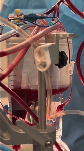 Cardiac Perfusion technology during heart surgery | #perfusion #perfusionist