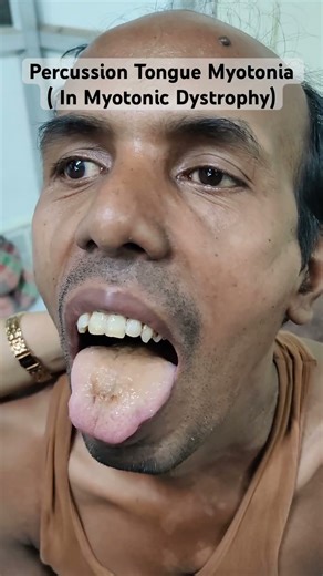 Percussion Myotonia - Myotonic Dystrophy #neurology #clinic #neetpg #neet