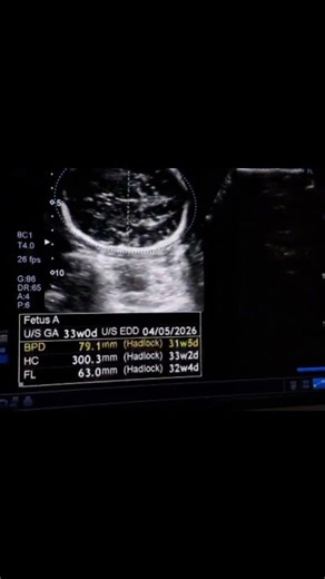 head circumference measurements taking method on ultrasound #ultrasound #fetus #radiology #obs