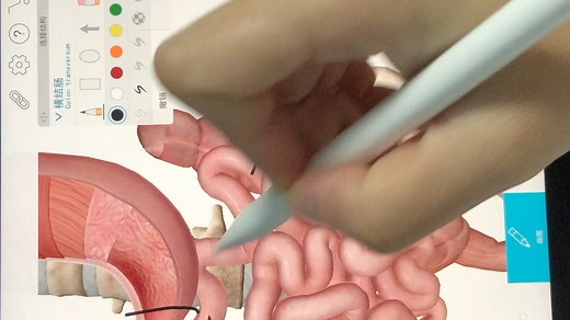 Roux-en-y术式简单讲解。欢迎有幸看见这个视频的同学指正up主👏🏻