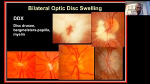 Approach to the Patient with Bilateral Optic Disc Swelling