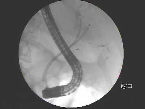 EPIC biliary stent placement
