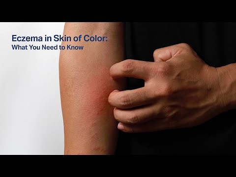 Eczema in skin of color: What you need to know