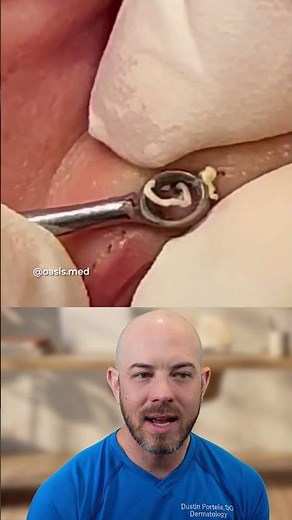 Whitehead Removal Technique: Needle vs. Plasma Pen