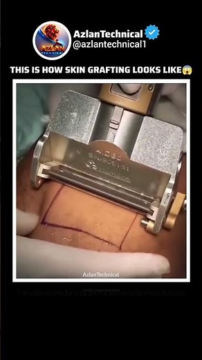 What Does Skin Grafting Look Like? Full Surgical Breakdown #science #medical #surgery