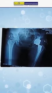 Fifteen years of pain ended in just one surgery. After enduring a fractured hip for over a decade, this patient underwent Hip Replacement and is now walking freely, enjoying life without constant discomfort. The sooner hip problems are addressed, the sooner recovery begins. Do not let long-standing pain dictate your future. Book a consultation today. 📞 91 99990 74744 📍 CK Birla Hospital, West Punjabi Bagh, New Delhi 🔗 drashwanimaichand.com (hip replacement surgery Delhi, hip fracture treatmen