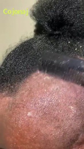 Storyless scratch! Video by Cojonaj on YouTube!! #dandruff #dandruffremoval #dandruffproblem #soothing #anxiety #foryou #satisfying #fyp #viral #dandruffscratching