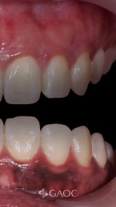 6.5K views · 81 reactions | Lighten discolored gums with ease at...